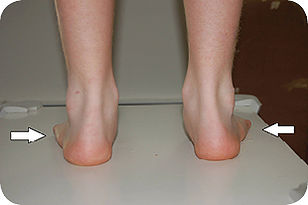 Çocuğunuz Sık Sık Düşüyor mu? Çocuklarda İçe Basma ve Düz Tabanlık Rehberi